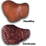 photo of a healthy liver and a liver with cirrhosis - liver damage from alcohol - breakaway hired power