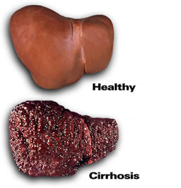 photo of a healthy liver and a liver with cirrhosis - liver damage from alcohol - hired power breakaway