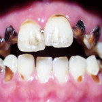 photo of a mouth with teeth decayed from methamphetamine use - breakaway hired power - meth tooth decay and skin sores